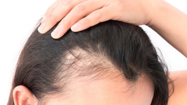 女性の生え際やⅯ字がハゲる2つの薄毛の原因について発毛技能士が解説します。