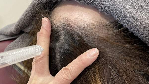 【頭皮画像】施術による頭皮の毛穴づまりの改善