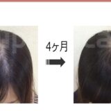 20女性の薄毛改善【発毛症例】