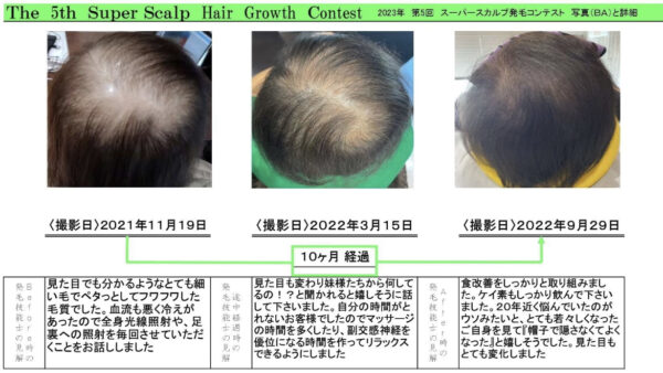 【69歳女性発毛症例】白髪染めを育毛効果があるヘナに変更