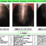 【67歳女性発毛症例】薬無し4ヶ月で薄毛改善