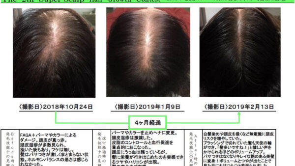 【67歳女性発毛症例】薬無し4ヶ月で薄毛改善