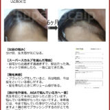 【52歳女性発毛症例】生え際の薄毛の原因と対策