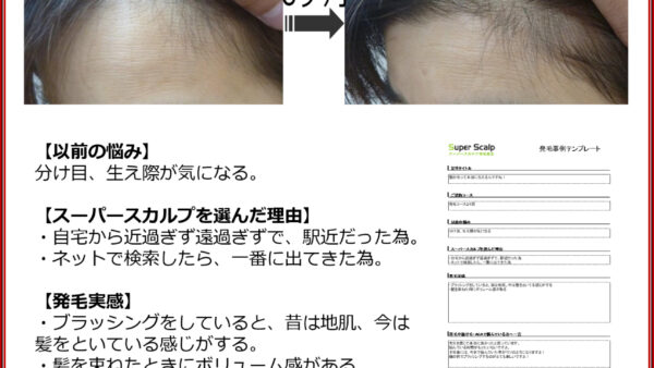 【52歳女性発毛症例】生え際の薄毛の原因と対策