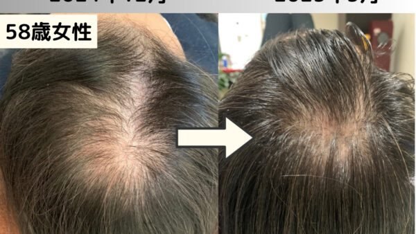 【発毛症例】58歳女性｜薬を使わず薄毛改善に成功！驚きのビフォーアフターとクチコミ