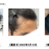 【21歳男性】プロによる頭皮ケアで発毛！M字薄毛が改善しました。