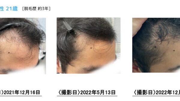 【21歳男性】プロによる頭皮ケアで発毛！M字薄毛が改善しました。