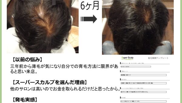【32歳男性】発毛ビフォーアフター