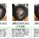 【発毛実績】42歳男性薬なし6ヶ月間の発毛コースで劇的に薄毛が改善