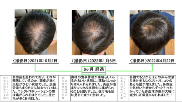 【発毛実績】42歳男性薬なし6ヶ月間の発毛コースで劇的に薄毛が改善