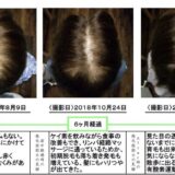 【薬なし】50代女性発毛症例ビフォーアフター