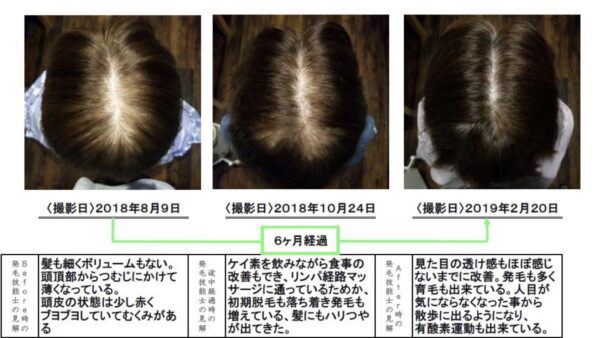 【薬なし】50代女性発毛症例ビフォーアフター