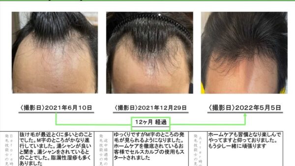 薬を使わずにここまで変わる！30代男性のM字改善と脂漏性皮膚炎ケアの症例