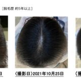 【薬を飲まずに発毛】ミノタブを断念した女性が発毛成功した事例をご紹介します。
