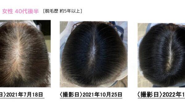 【薬を飲まずに発毛】ミノタブを断念した女性が発毛成功した事例をご紹介します。
