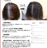 【32歳女性発毛症例】冬の頭皮ケアで分け目の薄毛が改善したお客様の実例