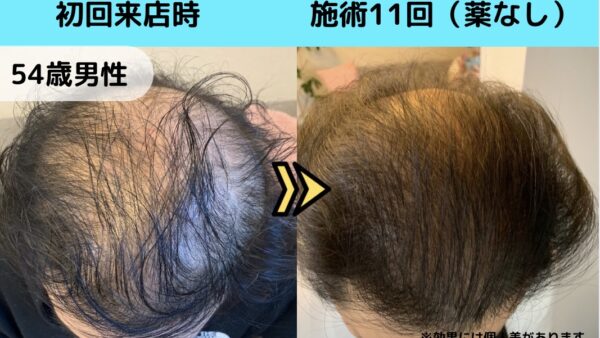 【発毛症例】54歳男性・薬を使わず施術11回の凄い変化【髪が伸びるスピードが違う】