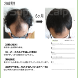 【29歳男性のAGA改善症例】6か月でここまで変化しました。