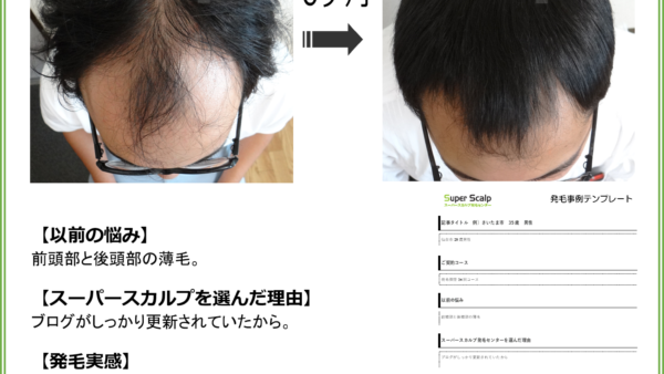 【29歳男性のAGA改善症例】6か月でここまで変化しました。