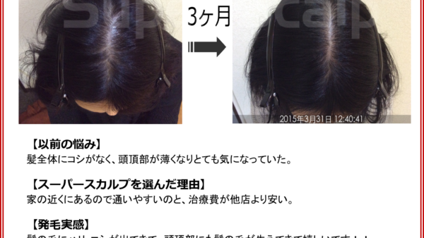 【40代女性・発毛症例】薬に頼らず3ヶ月で頭頂部のボリュームを実感｜発毛コース12回