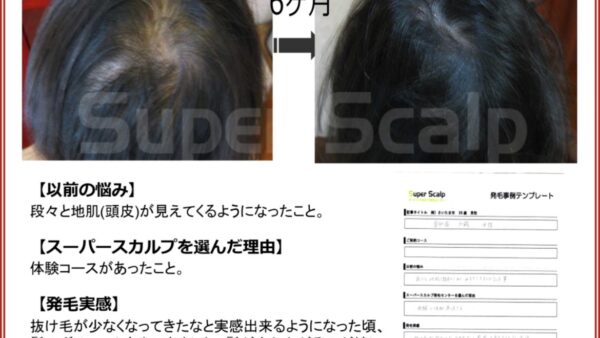 「鏡を見るのが楽しくなりました」50代女性薄毛改善事例