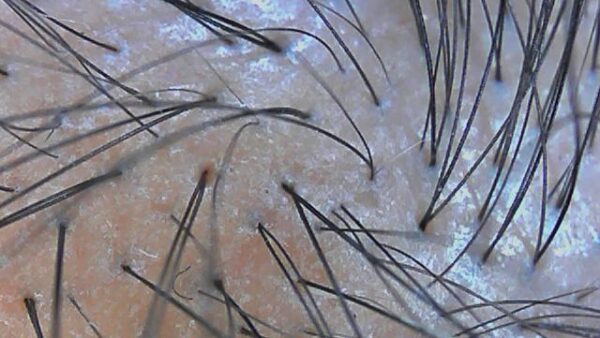 【夏に抜け毛が増える？】夏に多い薄毛の原因５選