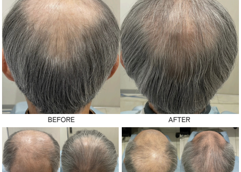 【男性の発毛症例】薄毛歴30年・60歳男性が3ヶ月で実感した髪の変化